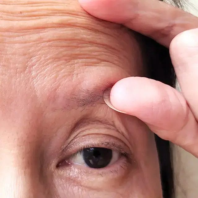 How Upper Blepharoplasty Works